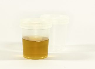 Niewydolność nerek – przyczyny, objawy i sposoby leczenia niewydolność nerek