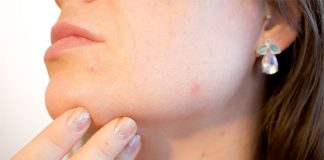 pierwsza faza rozwoju trądziku