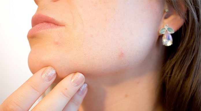 pierwsza faza rozwoju trądziku